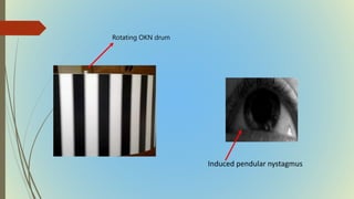 Rotating OKN drum
Induced pendular nystagmus
 
