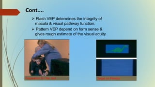  Flash VEP determines the integrity of
macula & visual pathway function.
 Pattern VEP depend on form sense &
gives rough estimate of the visual acuity.
Target on Monitor
Preparation for the test
Cont….
 