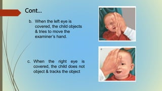 b. When the left eye is
covered, the child objects
& tries to move the
examiner’s hand.
Cont…
c. When the right eye is
covered, the child does not
object & tracks the object
 