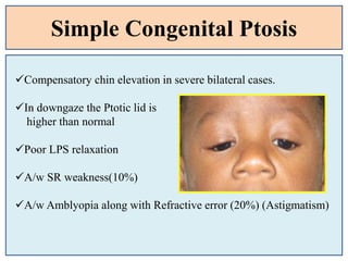 Simple Congenital Ptosis
Compensatory chin elevation in severe bilateral cases.
In downgaze the Ptotic lid is
higher than normal
Poor LPS relaxation
A/w SR weakness(10%)
A/w Amblyopia along with Refractive error (20%) (Astigmatism)
 