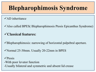 Blepharophimosis Syndrome
AD inheritance
Also called BPES( Blepharophimosis Ptosis Epicanthus Syndrome)
Classical features:
Blepharophimosis: narrowing of horizontal palpebral aperture.
Normal 25-30mm. Usually 20-22mm in BPES
Ptosis
-With poor levator function
-Usually bilateral and symmetric and absent lid crease
 