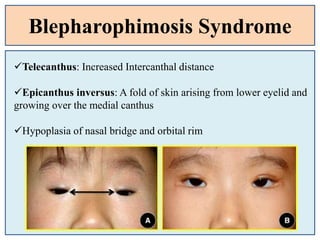 Blepharophimosis Syndrome
Telecanthus: Increased Intercanthal distance
Epicanthus inversus: A fold of skin arising from lower eyelid and
growing over the medial canthus
Hypoplasia of nasal bridge and orbital rim
 