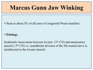 Marcus Gunn Jaw Winking
Seen in about 5% of all cases of congenital Ptosis manifest
Etiology:
Synkinetic innervation between levator (3rd CN) and masticatory
muscle ( 5th CN) i.e. mandibular division of the 5th cranial nerve is
misdirected to the levator muscle.
 