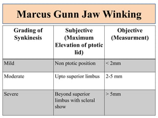 Grading of
Synkinesis
Subjective
(Maximum
Elevation of ptotic
lid)
Objective
(Measurment)
Mild Non ptotic position < 2mm
Moderate Upto superior limbus 2-5 mm
Severe Beyond superior
limbus with scleral
show
> 5mm
Marcus Gunn Jaw Winking
 