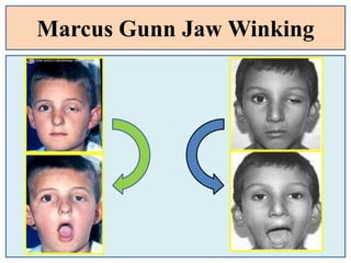 Marcus Gunn Jaw Winking
 