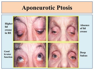 Aponeurotic Ptosis
Good
levator
function
Higher
lid
crease
in RE
Absence
of lid
crease
Deep
Sulcus
 