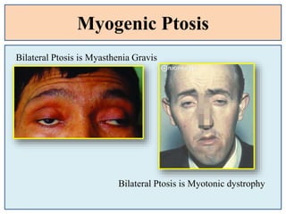 Myogenic Ptosis
Bilateral Ptosis is Myasthenia Gravis
Bilateral Ptosis is Myotonic dystrophy
 