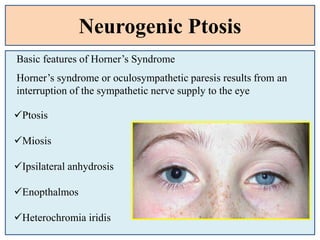 Neurogenic Ptosis
Basic features of Horner’s Syndrome
Ptosis
Miosis
Ipsilateral anhydrosis
Enopthalmos
Heterochromia iridis
Horner’s syndrome or oculosympathetic paresis results from an
interruption of the sympathetic nerve supply to the eye
 