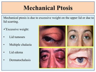 Mechanical Ptosis
Mechanical ptosis is due to excessive weight on the upper lid or due to
lid scarring.
Excessive weight:
• Lid tumours
• Multiple chalazia
• Lid edema
• Dermatochalasis
 
