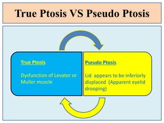 True Ptosis VS Pseudo Ptosis
True Ptosis
Dysfunction of Levator or
Muller muscle
Pseudo Ptosis
Lid appears to be inferiorly
displaced (Apparent eyelid
drooping)
 