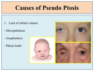 Causes of Pseudo Ptosis
1. Lack of orbital volume:
- Micropthalmos
- Anopthalmos
- Pthisis bulbi
 