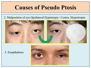 Causes of Pseudo Ptosis
2. Malposition of eye (Ipsilateral Hypotropia / Contra. Hypertropia
3. Enopthalmos
 