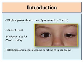 Introduction
Blepharoptosis, abbrev. Ptosis (pronounced as “toe-sis)
Ancient Greek:
-Blepharon: Eye lid
-Ptosis: Falling
Blepharoptosis means drooping or falling of upper eyelid.
 