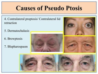 Causes of Pseudo Ptosis
4. Contralateral proptosis/ Contralateral lid
retraction
5. Dermatochalasis
6. Browptosis
7. Blepharospasm
 
