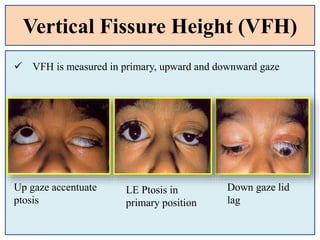 Vertical Fissure Height (VFH)
 VFH is measured in primary, upward and downward gaze
Up gaze accentuate
ptosis
Down gaze lid
lag
LE Ptosis in
primary position
 