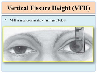 Vertical Fissure Height (VFH)
 VFH is measured as shown in figure below
 