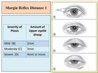 Margin Reflex Distance 1
Severity of
Ptosis
Amount of
Upper eyelid
droop
Mild (B) 2mm
Moderate (C) 3mm
Severe (D) 4mm or more
 