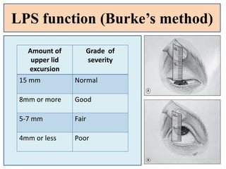 LPS function (Burke’s method)
Amount of
upper lid
excursion
Grade of
severity
15 mm Normal
8mm or more Good
5-7 mm Fair
4mm or less Poor
 