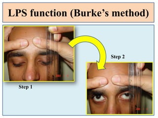 LPS function (Burke’s method)
Step 1
Step 2
 