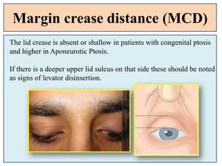 Margin crease distance (MCD)
The lid crease is absent or shallow in patients with congenital ptosis
and higher in Aponeurotic Ptosis.
If there is a deeper upper lid sulcus on that side these should be noted
as signs of levator disinsertion.
 