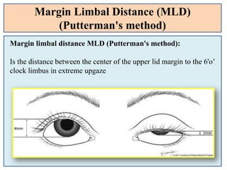 Margin Limbal Distance (MLD)
(Putterman's method)
Margin limbal distance MLD (Putterman's method):
Is the distance between the center of the upper lid margin to the 6'o’
clock limbus in extreme upgaze
 