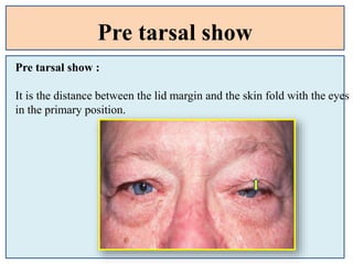 Pre tarsal show
Pre tarsal show :
It is the distance between the lid margin and the skin fold with the eyes
in the primary position.
 