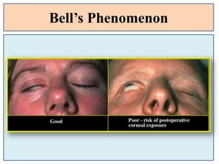 Bell’s Phenomenon
 