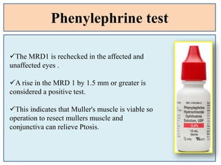 Phenylephrine test
The MRD1 is rechecked in the affected and
unaffected eyes .
A rise in the MRD 1 by 1.5 mm or greater is
considered a positive test.
This indicates that Muller's muscle is viable so
operation to resect mullers muscle and
conjunctiva can relieve Ptosis.
 