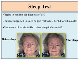 Sleep Test
Helps to confirm the diagnosis of MG
Patient suggested to sleep or give rest to his/ her lid for 30 minutes
Improvent of ptosis (MRD 1) after sleep indicates MG
Before sleep After sleep
 