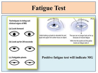 Fatigue Test
Positive fatigue test will indicate MG
 