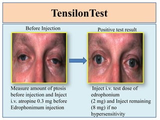 TensilonTest
Measure amount of ptosis
before injection and Inject
i.v. atropine 0.3 mg before
Edrophonimum injection
Inject i.v. test dose of
edrophonium
(2 mg) and Inject remaining
(8 mg) if no
hypersensitivity
Before Injection Positive test result
 