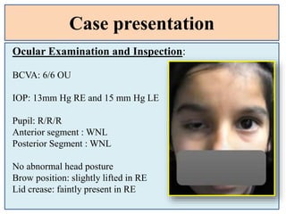 Case presentation
Ocular Examination and Inspection:
BCVA: 6/6 OU
IOP: 13mm Hg RE and 15 mm Hg LE
Pupil: R/R/R
Anterior segment : WNL
Posterior Segment : WNL
No abnormal head posture
Brow position: slightly lifted in RE
Lid crease: faintly present in RE
 