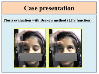 Case presentation
Ptosis evaluation with Berke’s method (LPS function) :
 