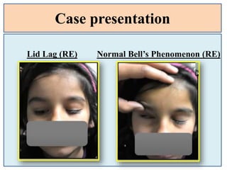 Case presentation
Lid Lag (RE) Normal Bell’s Phenomenon (RE)
 