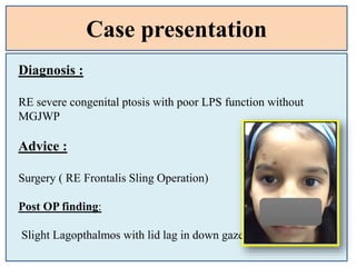 Case presentation
Diagnosis :
RE severe congenital ptosis with poor LPS function without
MGJWP
Advice :
Surgery ( RE Frontalis Sling Operation)
Post OP finding:
Slight Lagopthalmos with lid lag in down gaze
 
