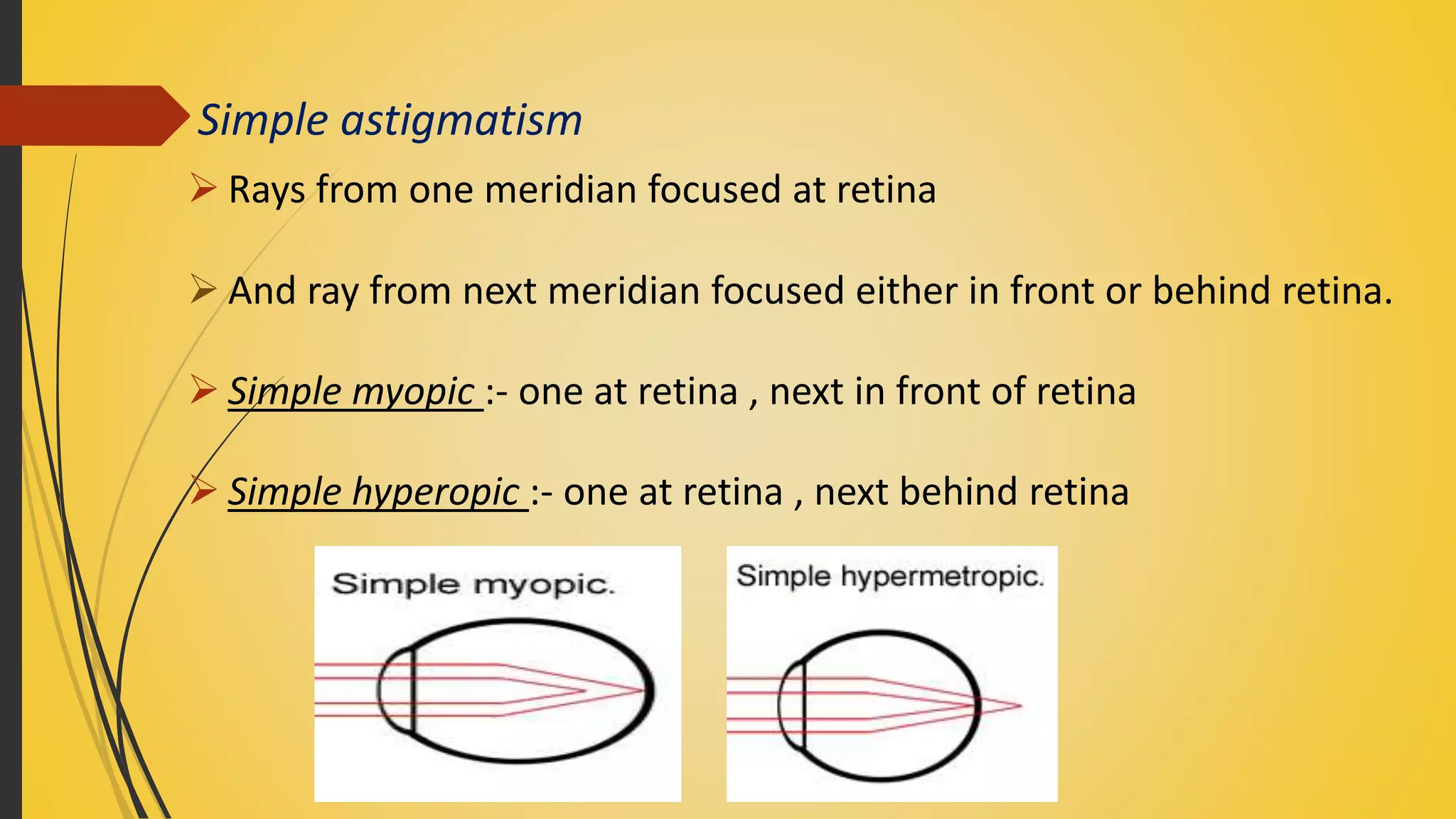 Simple astigmatism
 Rays from one meridian focused at retina
 And ray from next meridian focused either in front or behind retina.
 Simple myopic :- one at retina , next in front of retina
 Simple hyperopic :- one at retina , next behind retina
 