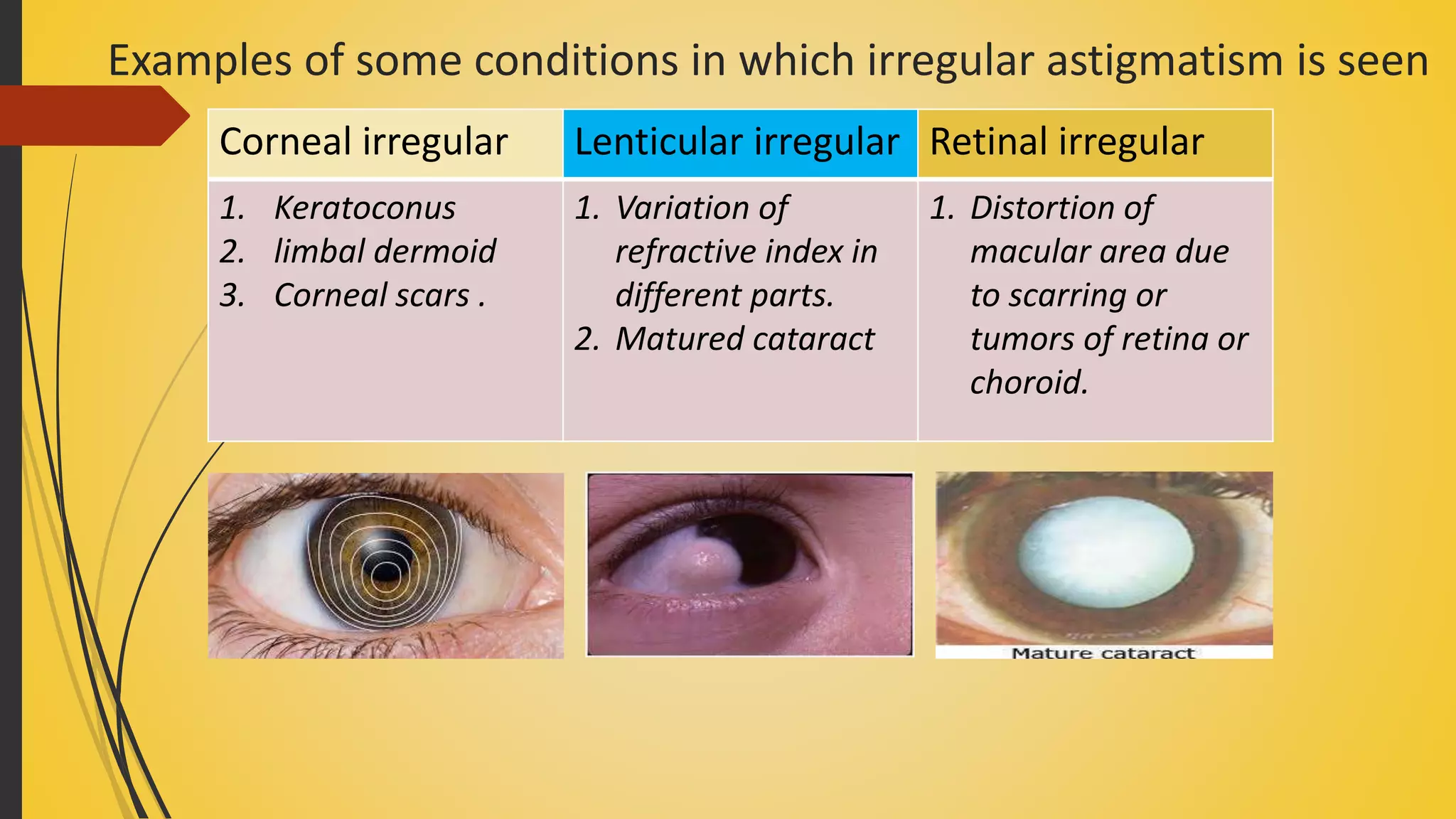 Examples of some conditions in which irregular astigmatism is seen
Corneal irregular Lenticular irregular Retinal irregular
1. Keratoconus
2. limbal dermoid
3. Corneal scars .
1. Variation of
refractive index in
different parts.
2. Matured cataract
1. Distortion of
macular area due
to scarring or
tumors of retina or
choroid.
 
