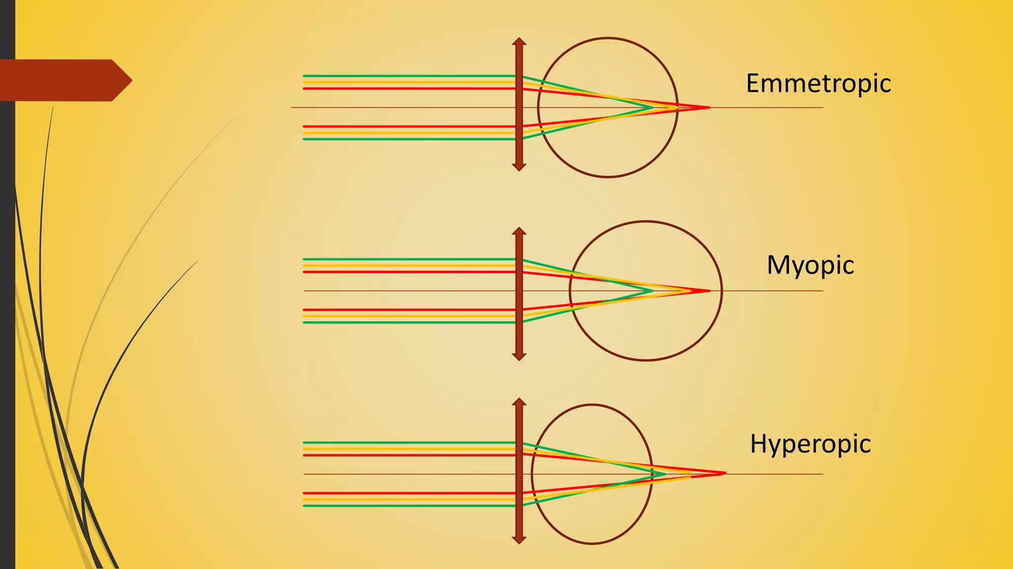 Emmetropic
Myopic
Hyperopic
 