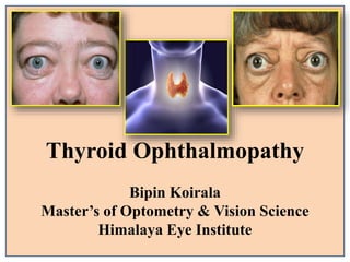 Thyroid Ophthalmopathy
Bipin Koirala
Master’s of Optometry & Vision Science
Himalaya Eye Institute
 