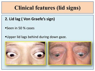 Clinical features (lid signs)
G
2. Lid lag ( Von Graefe’s sign)
Seen in 50 % cases
Upper lid lags behind during down gaze.
 
