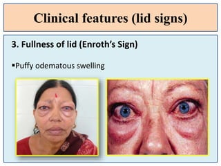 Clinical features (lid signs)
3. Fullness of lid (Enroth’s Sign)
Puffy odematous swelling
 