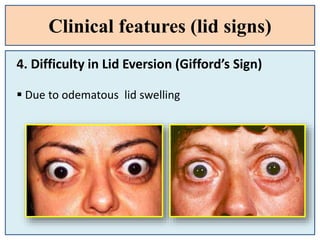 Clinical features (lid signs)
4. Difficulty in Lid Eversion (Gifford’s Sign)
 Due to odematous lid swelling
 