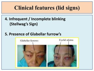 Clinical features (lid signs)
4. Infrequent / Incomplete blinking
(Stellwag’s Sign)
5. Presence of Glabellar furrow’s
 