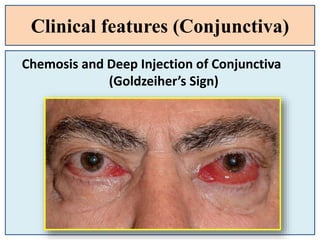 Clinical features (Conjunctiva)
Chemosis and Deep Injection of Conjunctiva
(Goldzeiher’s Sign)
 