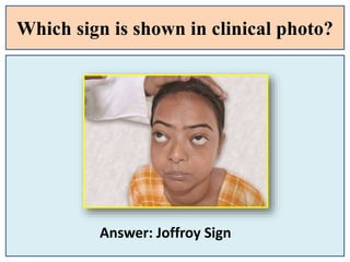 Which sign is shown in clinical photo?
Answer: Joffroy Sign
 
