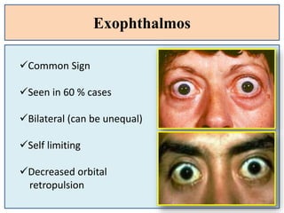 Exophthalmos
Common Sign
Seen in 60 % cases
Bilateral (can be unequal)
Self limiting
Decreased orbital
retropulsion
 