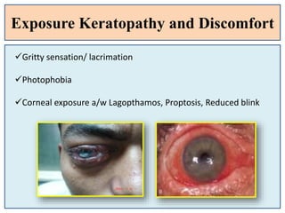Exposure Keratopathy and Discomfort
Gritty sensation/ lacrimation
Photophobia
Corneal exposure a/w Lagopthamos, Proptosis, Reduced blink
 