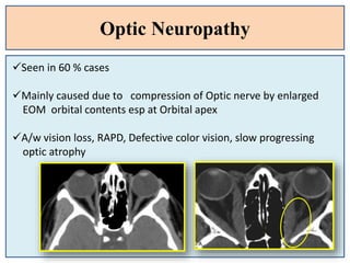 Optic Neuropathy
Seen in 60 % cases
Mainly caused due to compression of Optic nerve by enlarged
EOM orbital contents esp at Orbital apex
A/w vision loss, RAPD, Defective color vision, slow progressing
optic atrophy
 