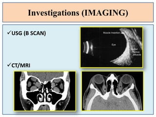 Investigations (IMAGING)
USG (B SCAN)
CT/MRI
 