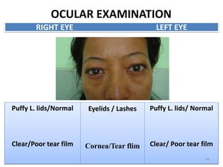 OCULAR EXAMINATION
Puffy L. lids/Normal
Clear/Poor tear film
Eyelids / Lashes
Cornea/Tear flim
Puffy L. lids/ Normal
Clear/ Poor tear film
RIGHT EYE LEFT EYE
66
 